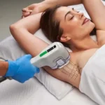 Imagem destacada sobre miraDry tratamento para suor excessivo
