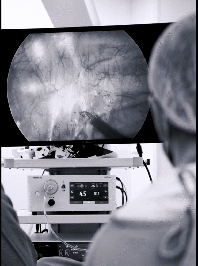 Simpatectomia torácica por videotoracoscopia - incisões mínimas de 5-10mm para hiperidrose